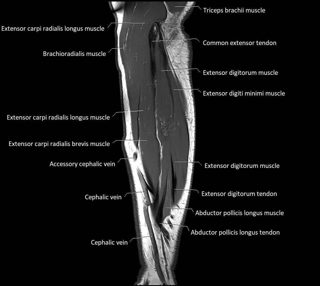 MRI 3T forearm sagittal labelled cross sectional anatomy image 12.webp